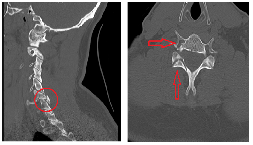 Cervical Neck Fractures Shim Spine