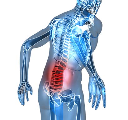 Low back Sprain-Strain - ShimSpine
