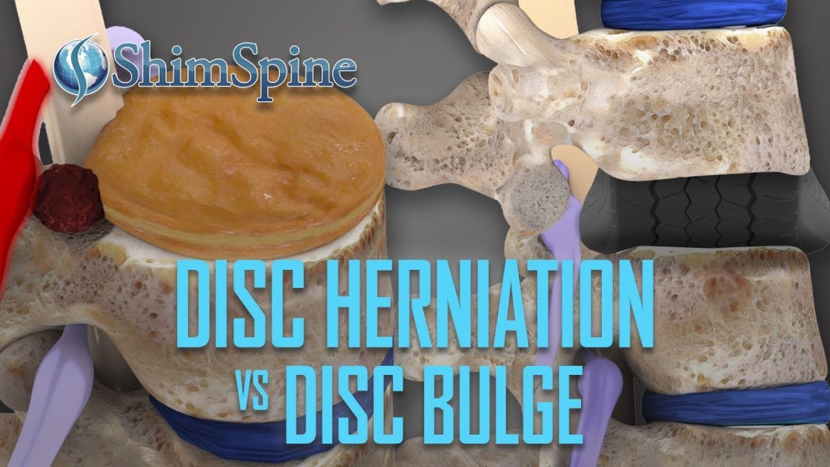 Disc Herniation vs Disc Bulge - ShimSpine