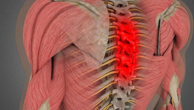 thoracic-spinal-stenosis-shimspine