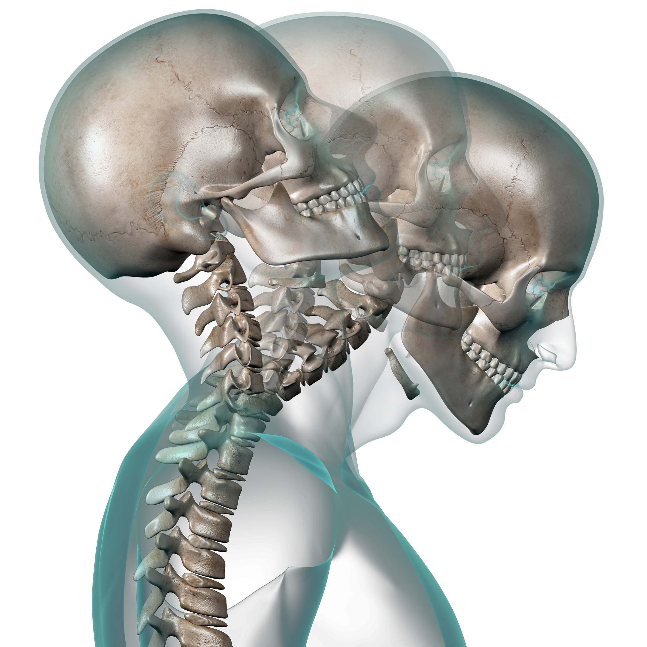 Whiplash Cervical Strain Cervical Sprain ShimSpine